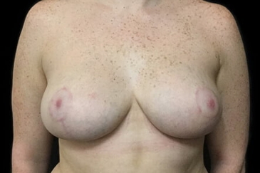 breast reduction after photo Dr David Sharp plastic surgeon