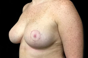 breast reduction after photo plastic surgeon Dr Sharp