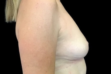 breast reduction and implant removal plastic surgeon dr david sharp brisbane clinic results after