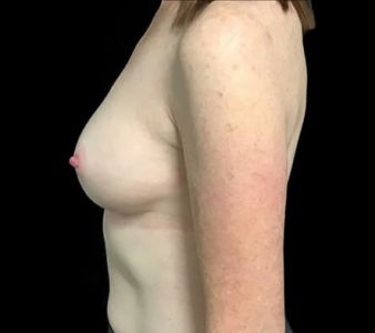 Breast Augmentation - 274
