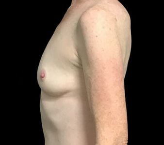 Breast augmentation - 260