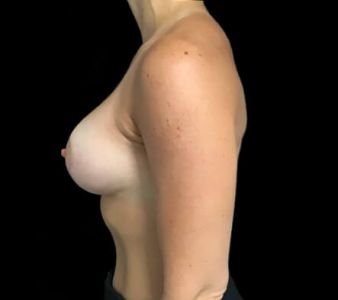 breast augmentation and lift MM 5