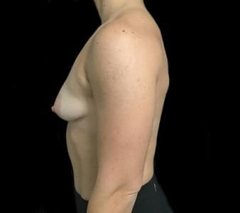 breast augmentation and lift MM 6