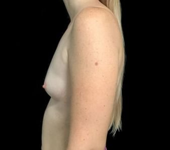 breast augmentation brisbane Dr Sharp 375 motiva round full profile KP 3