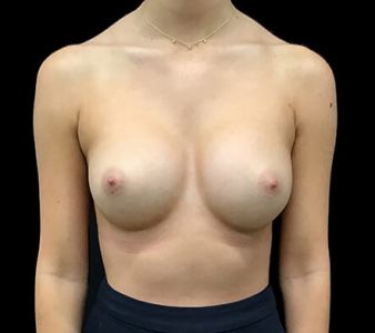breast implants 330 cc anatomical mod plus profile KL 2