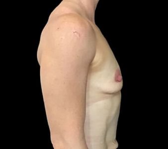breast implants Brisbane Dr Sharp 375 anatomical mod plus KI 1
