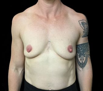 breast implants Brisbane Dr Sharp 375 anatomical mod plus KI 3