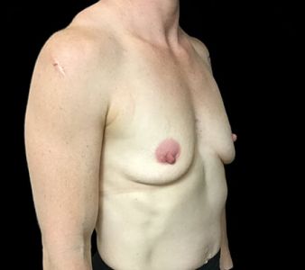 breast implants Brisbane Dr Sharp 375 anatomical mod plus KI 5