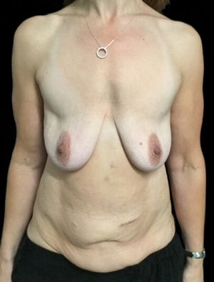 breast lift augmentation and abdominoplasty body lift mummy makeover Dr Sharp 1 JL
