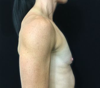 e. Breast augmentation Brisbane surgeon for fit woman before photo
