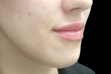 lip filler The Sharp Clinics Brisbane Ipswich IS 1 after one and a half mls