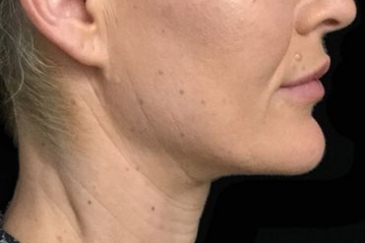 neck lift facelift surgery Brisbane SM 1