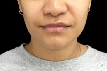 necklift jaw facial slimming injections after HL
