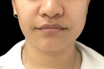 necklift jaw slimming injections before HL