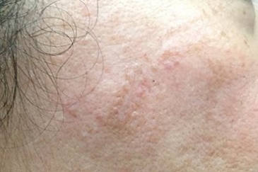 scar treatment with Fraxel Brisbane after