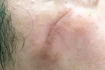 scar treatment with Fraxel Brisbane before