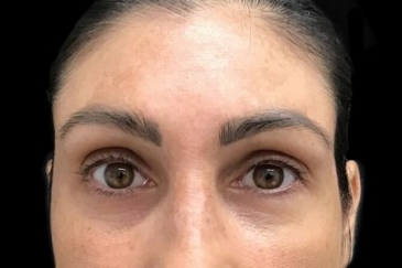 stress lines wrinkle injections frown lines after 2