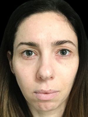 Facial and Revolumising Fillers - 39
