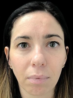 Facial and Revolumising Fillers - 40
