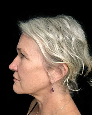 Studies examine patient satisfaction with facelift surgery - and the surgical vs non surgical quandary - 2