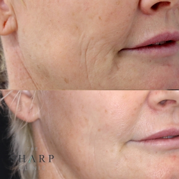 before and after Volite filler The Sharp Clinic