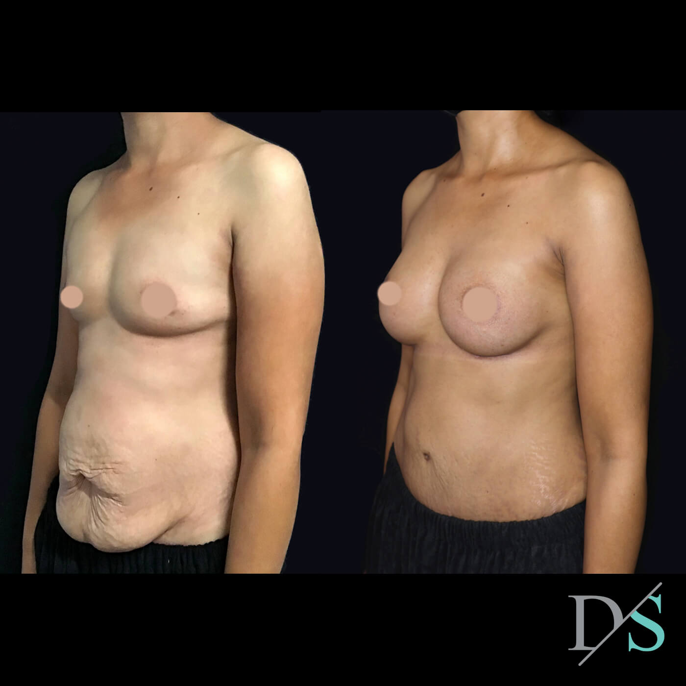 Post pregnancy abdominoplasty: can I claim a rebate for my tummy tuck? - 1