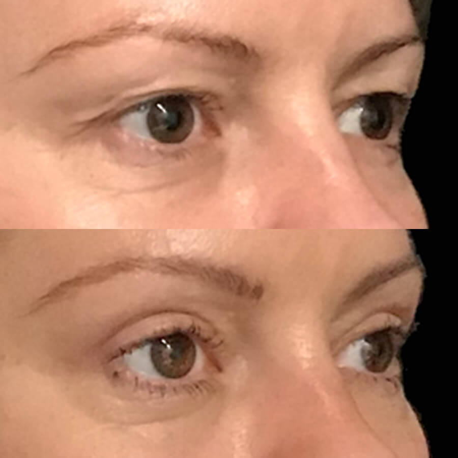 New eyelid reduction item number requirements announced - 1