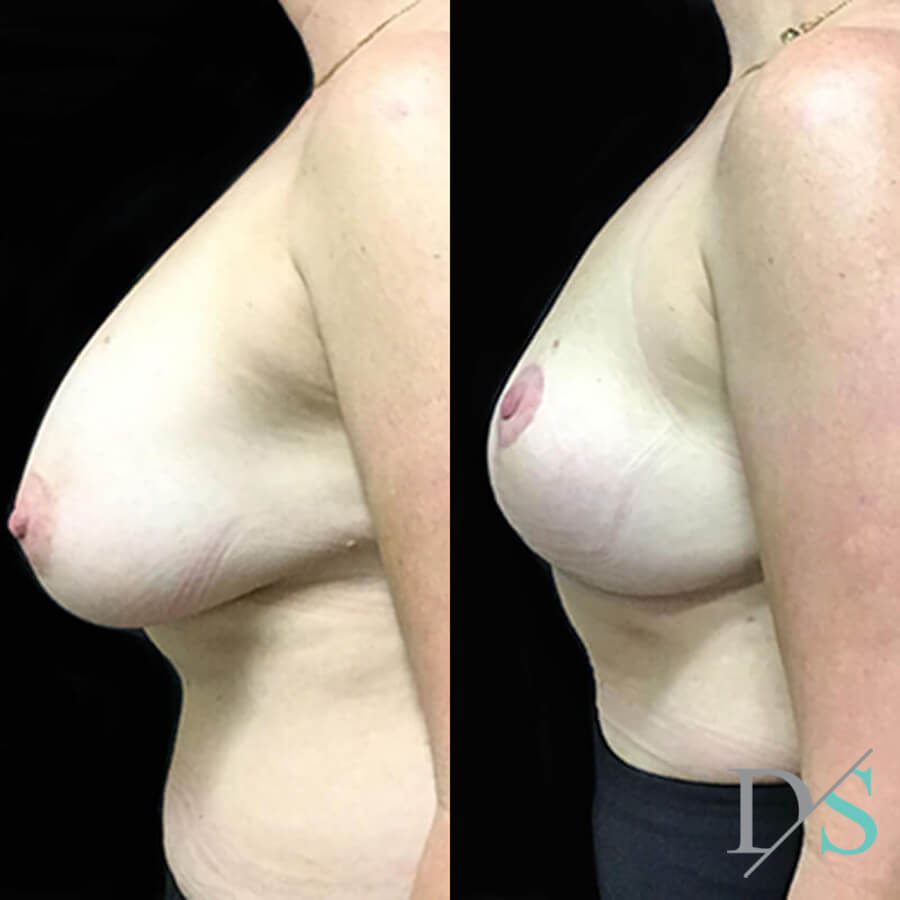 breast implant remove replace