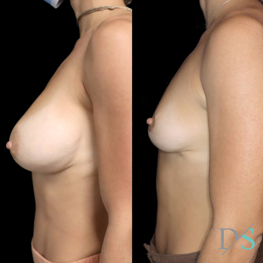 implant remove and lift plastic surgeon