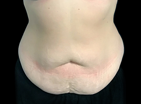 Postpartum abdominoplasty with abdominal wall reconstruction - 142