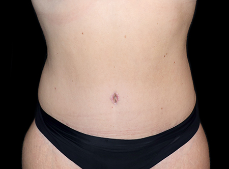 Postpartum abdominoplasty with abdominal wall reconstruction - 145