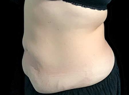 Postpartum abdominoplasty with abdominal wall reconstruction - 143