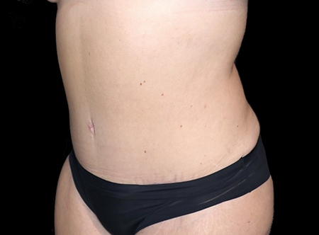 Postpartum abdominoplasty with abdominal wall reconstruction - 146