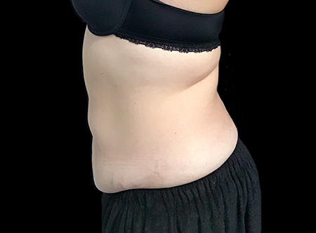 Postpartum abdominoplasty with abdominal wall reconstruction - 144