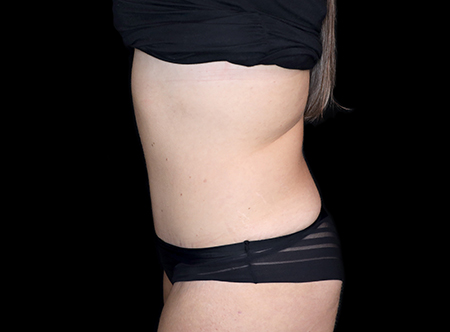 Postpartum abdominoplasty with abdominal wall reconstruction - 147