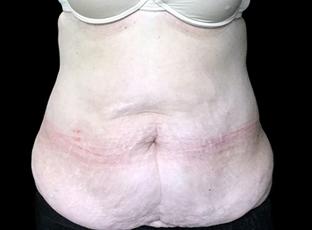Postpartum abdominoplasty with abdominal wall reconstruction - 118