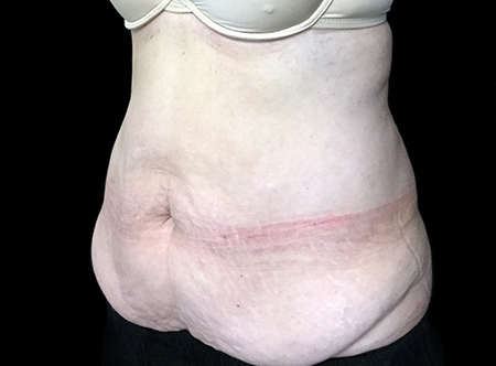 Postpartum abdominoplasty with abdominal wall reconstruction - 119