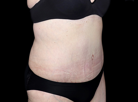 Postpartum abdominoplasty with abdominal wall reconstruction - 123
