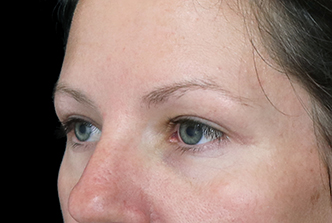 Blepharoplasty - Eyelid reduction - 30