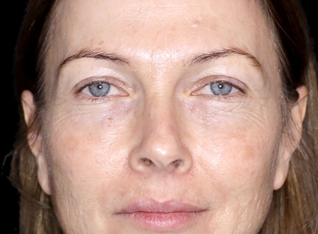 Wrinkle Injections - 10