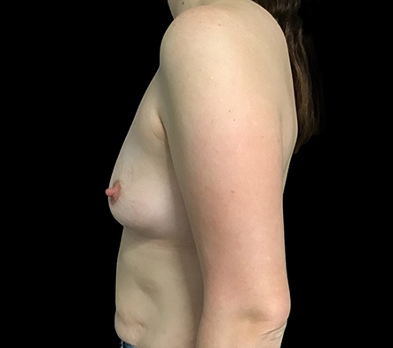 Medium breast implants - 81