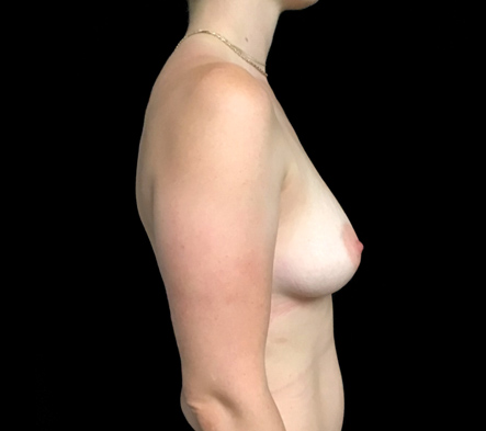 Medium breast implants - 75