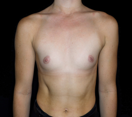 Breast augmentation - 320
