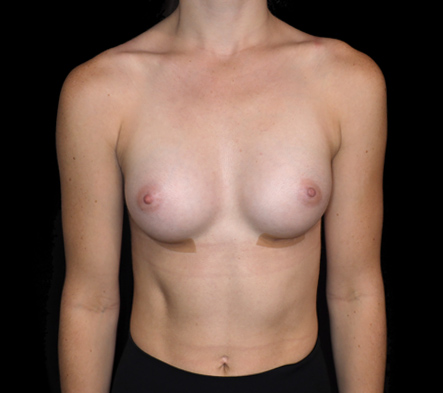 Small breast implants - 34
