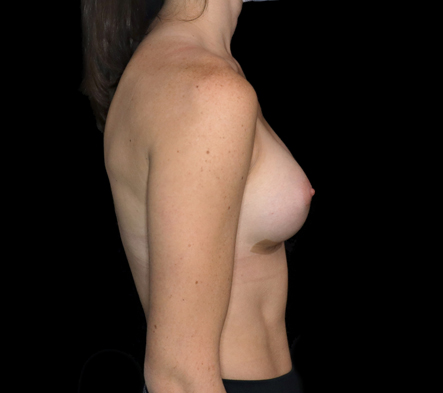 Small breast implants - 36