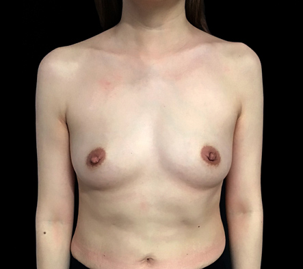 Medium breast implants - 55