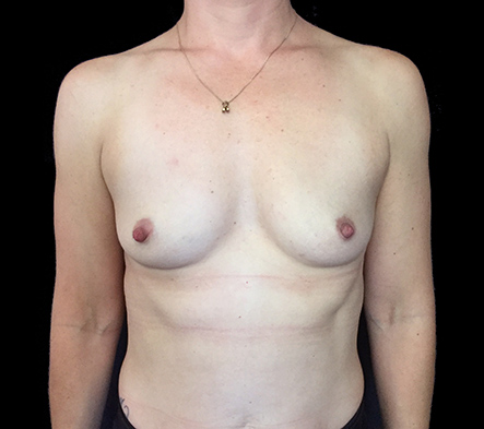 Medium breast implants - 49