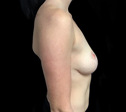 Large breast implants - 9