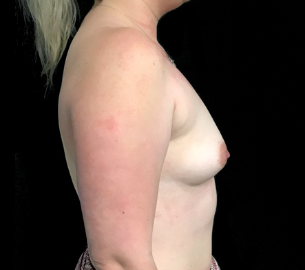 Medium breast implants - 45