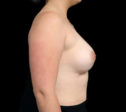 Medium breast implants - 48